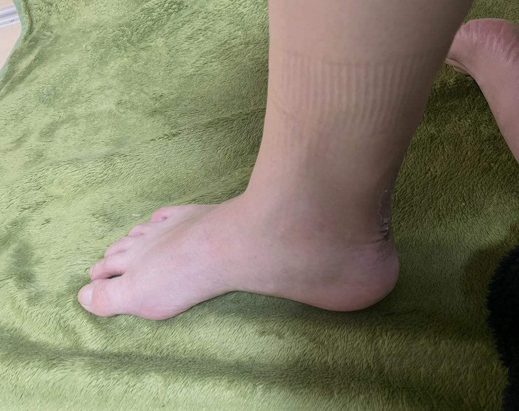 アキレス腱術後の傷跡がきれいに治癒した状態