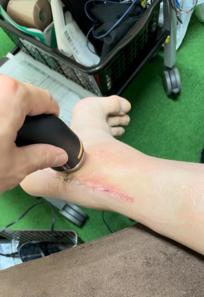 アキレス腱術後の患部への超音波治療